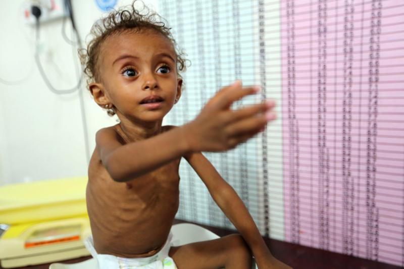 El hambre habría matado a 85 mil niños en Yemen
