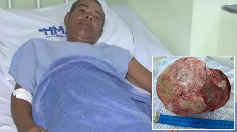 Hombre que tenía piedra de 1,3 kg en la vejiga glorifica a Dios tras sobrevivir