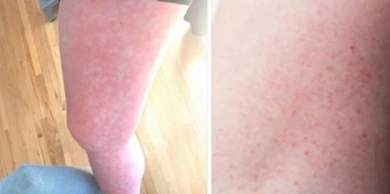 Médicos revelan nuevos síntomas del coronavirus en la piel